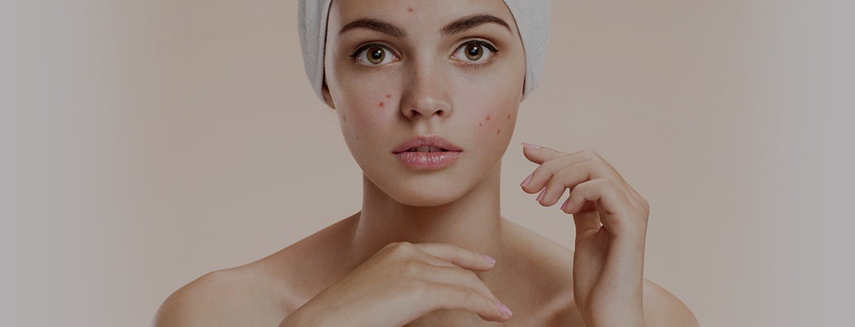 tratamento do acne