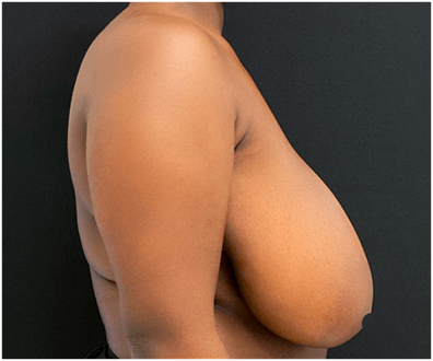 antes lateral mamoplastia de redução