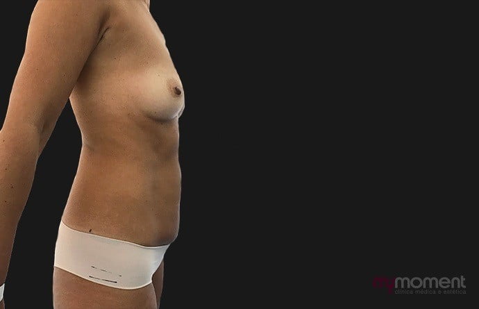 abdominoplastia lateral caso antes