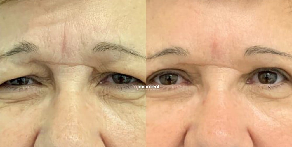 Blefaroplastia caso antes e depois frontal