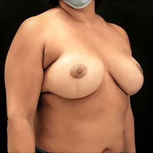 mamoplastia de redução caso depois lateral