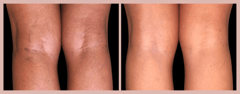 derrames nas pernas; antes e depois do tratamento