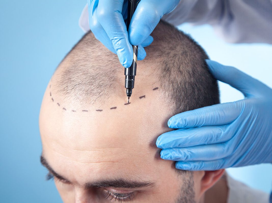 Tratamento da Alopecia