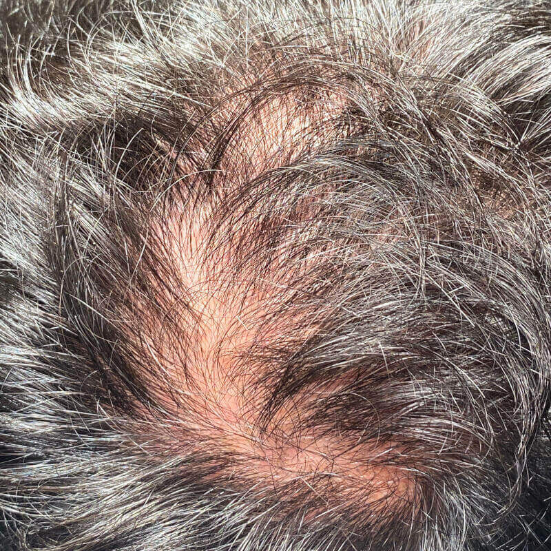 caso 15782 alopecia mymoment 1